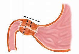 Hẹp Môn Vị Phì Đại Là Gì